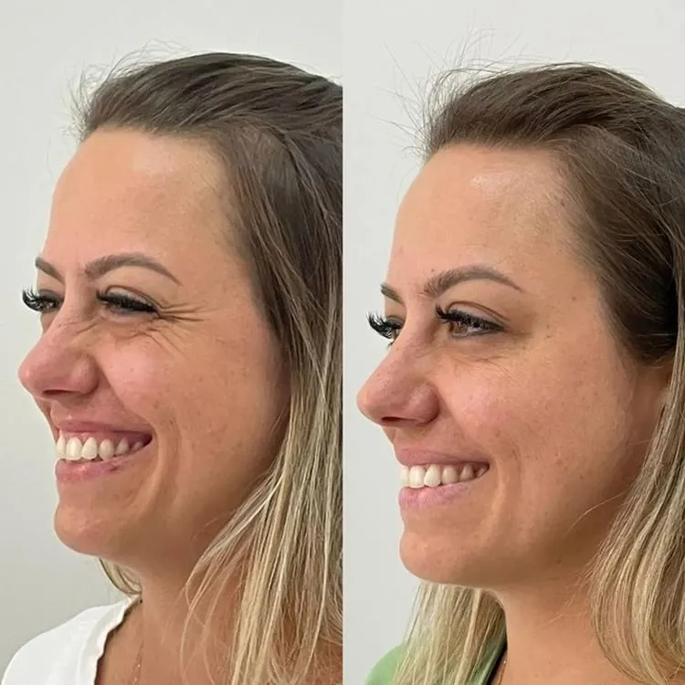 Antes e Depois Toxina Botulínica