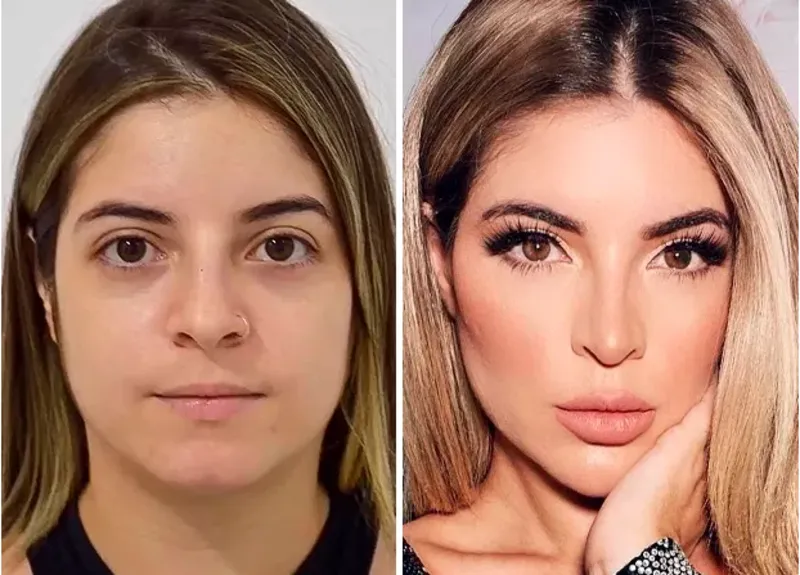 Antes e Depois Harmonização Orofacial