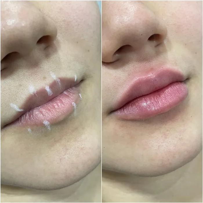 Antes e Depois Preenchimento Labial